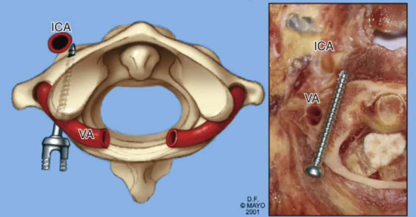 FIGURE 12-5  Diagram (A) and axial section from a fresh frozen cadaveric specimen (B) showing the risk of  C1 screw placement relative to the location of the ICA