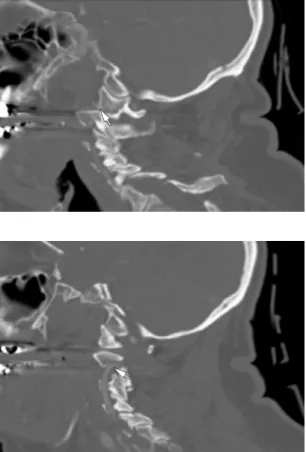 FIGURE 12-7  Sagittal CT image revealing  posterior subluxation of the left C1 lateral  mass on C2.