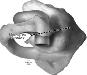 FIGURE  12-16  Lateral  view  of  C1  dem- dem-onstrating  the  ideal  orientation  of  screw  placement within the sagittal plane (10 to  15 degrees caudad to cephalad)