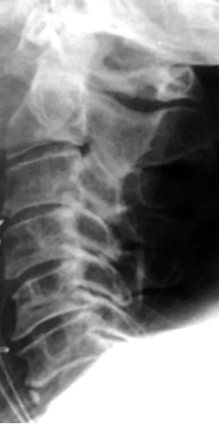 FIGURE 13-1  Lateral radiograph revealing diffuse spondy- spondy-losis in the subaxial cervical spine.