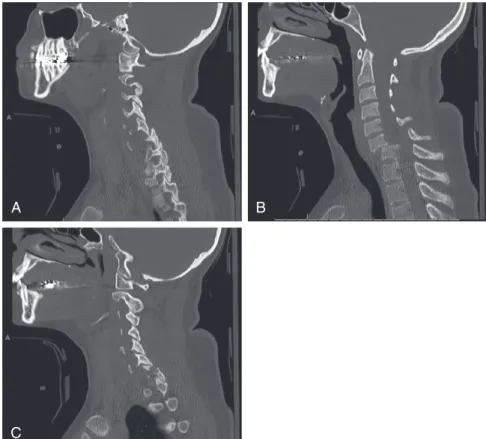 FIGURE 14-1  Sagittal CT reconstructions demonstrating C6-7 fracture dislocation with C5-6 and C6-7 dis- dis-located facets on the left (A) and a fractured C7 facet on the right (C)