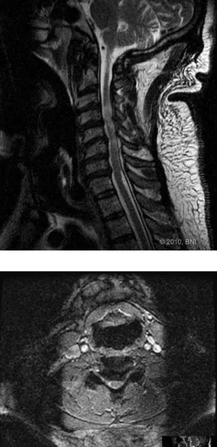 FIGURE  15-1  Sagittal  T2-weighted  MRI  scan of the cervical spine showing  straight-ening of the spine with circumferential  ste-nosis  secondary  to  spondylosis