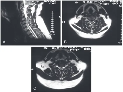FIGURE 1-2  MRI images at presentation.  A, T2-weighted sagittal image. B, T2-weighted axial image at  C4-5