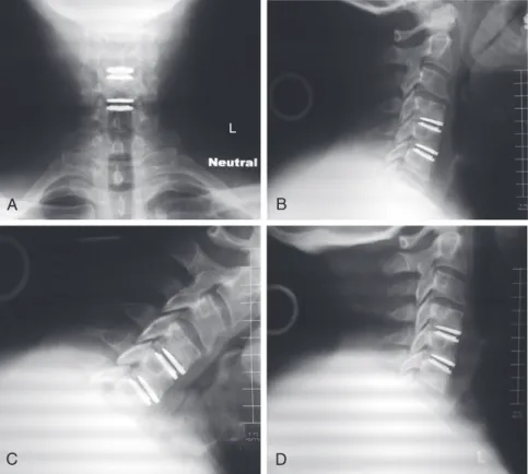 FIGURE 1-5  Radiographs obtained at 2-year follow-up. A, AP view.  B, Lateral view. C, Flexion