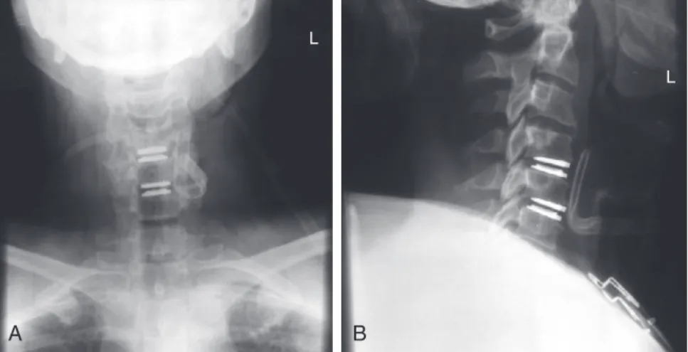 FIGURE 1-4  Radiographs taken immediately after surgery. A, AP view. B, Lateral view.
