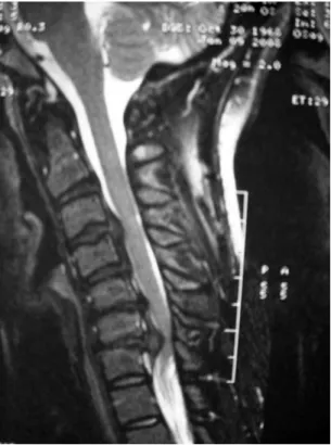 FIGURE  2-1  Preoperative  sagittal  T2- T2-weighted  MRI  scan  showing  multilevel  disk  herniations  causing  spinal  cord  compression.