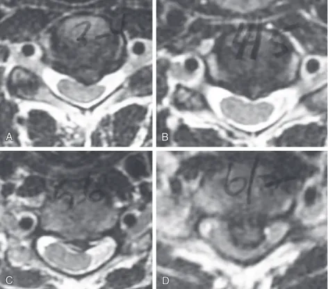 FIGURE 2-2  Preoperative axial T2-weighted MRI scan showing central and left posterolateral herniations  with multilevel cervical stenosis at C3-4 (A), C4-5 (B), C5-6 (C), and C6-7 (D).