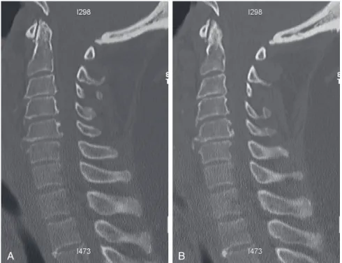 FIGURE 3-1  Preoperative sagittal CT scans demonstrating mixed-type OPLL from C3 to C7 with an increase  posterior to C5-6.