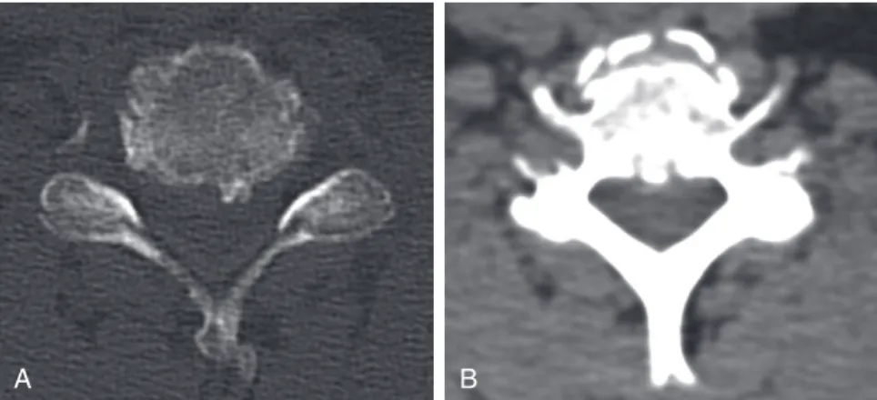 FIGURE 3-2  Axial CT scans demonstrating OPLL intrusion into the spinal canal.