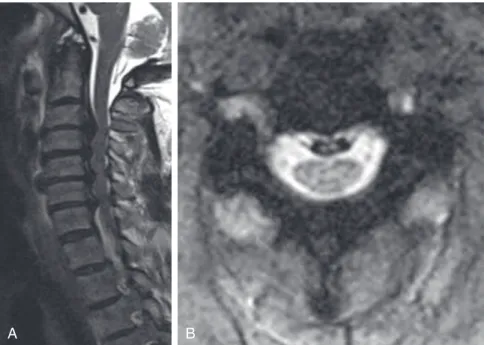 FIGURE 3-3  Sagittal and axial MRI images of OPLL effacing cerebrospinal fluid signal and compressing  the spinal cord.