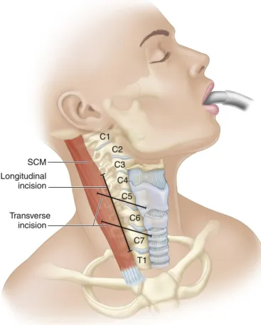 FIGURE  3-4  Palpable  landmarks  to  identify  the  appropriate  level  of  surgical  incision  for  the  anterior  approach to the cervical spine