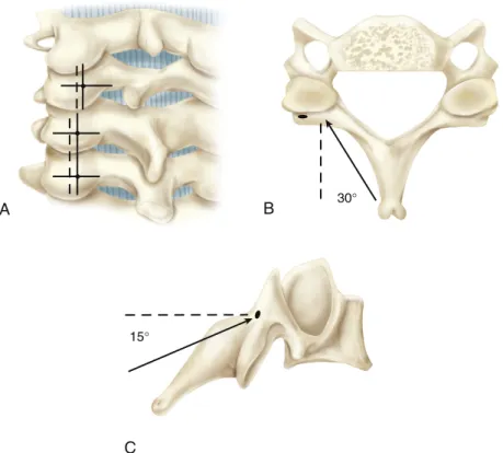 FIGURE 3-7  Placement of cervical lateral mass screws. A, Entry points for lateral mass screws 1 mm medial  to the midpoint of the lateral mass