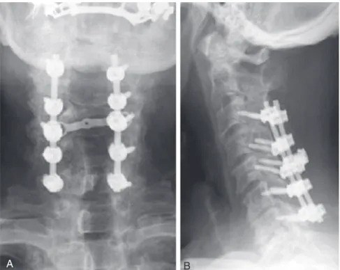 FIGURE 3-9  AP and lateral radiographs of a laminectomy and instrumented spinal fusion.
