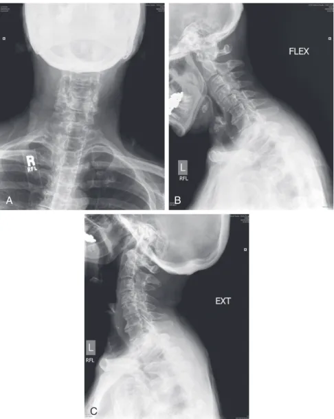 FIGURE 6-1  Anteroposterior (A) and lateral flexion (B) and extension (C) radiographs