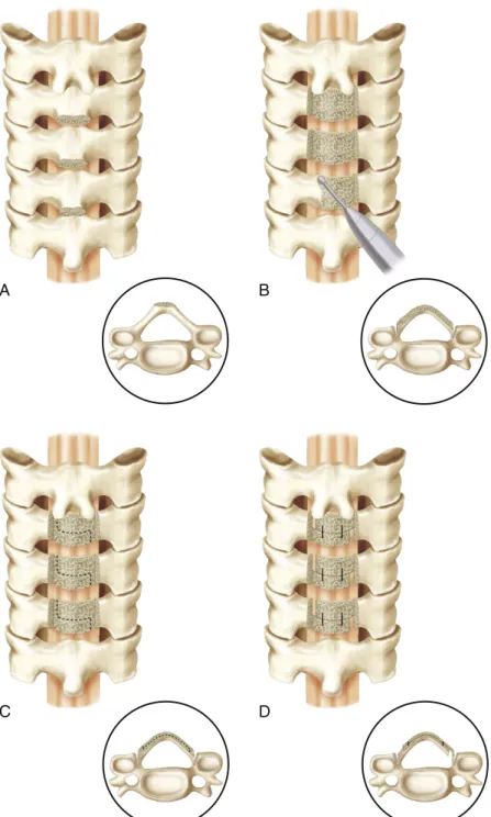 FIGURE  6-4  Original  Z-plasty  laminoplasty  technique.  The  spinous  processes  are  removed  (A)  and  the  laminae are then thinned (B)