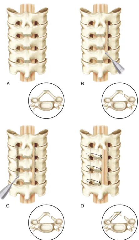 FIGURE 6-5  Open-door laminoplasty. The spinous processes are removed (A) and bilateral troughs created  at the facet-lamina junctions (B)