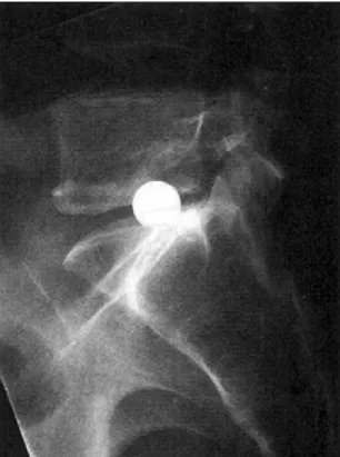 FIGURE 7-1  Radiograph depicting a Fern- Fern-ström ball within the L5-S1 disk space.