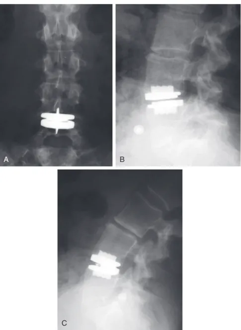 FIGURE 7-10  A, Immediately postoperative AP radiograph of L4-5 artificial disk replacement