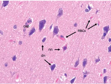 FIGURE 1 A single degenerating neuron (nn) is surrounded by many artifactually created dark neurons (dn)