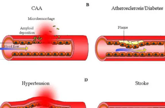 Figure 1. Different types of diseases with vascular pathology. (A) CAA is characterized in the  deposition of amyloid proteins around the blood vessels in the brain which may disrupt vascular  endothelium and induce microhemorrhage