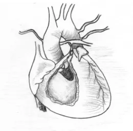 Figure 6.2. Pulmonary atresia. Note the very small (atretic) pulmonary artery (PA) and branch Pas