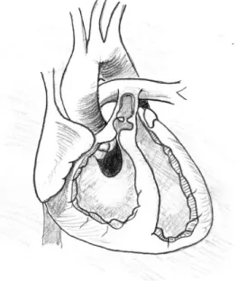 Figure 6.5. Tetralogy of Fallot. Note the VSD (with the root of the aorta shown overriding the VSD)