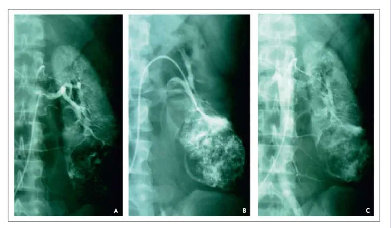 Figure 5 – Extracted gross specimen of the right kidney of K. patient, female, 35 years oldFigure 4 – Angiograms of the left kidney of K
