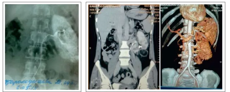 Figure 6 – Control angiography of the left  kidney of K. patient, female, 39 years old,  in 54 mon