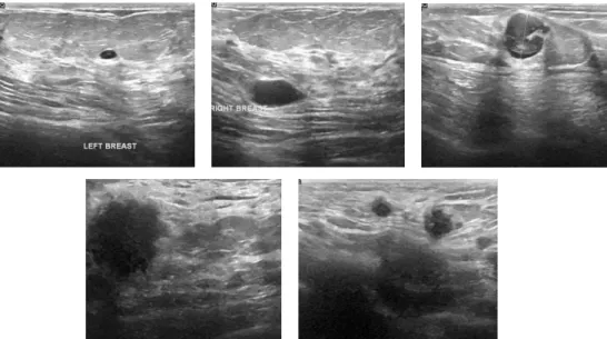 Figure 2: Ultrasound images (From top left: benign, benign, malignant, malignant,  malignant) 