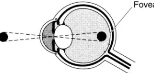 Figure 7-5 Myopia (nearsightedness).
