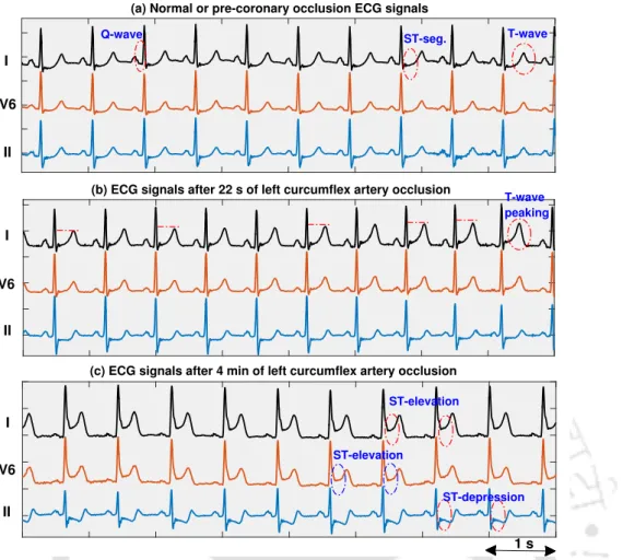 Figure 1.7: Typical ECG signals of a subject before and after left circumflex (LCx) coronary artery occlusion