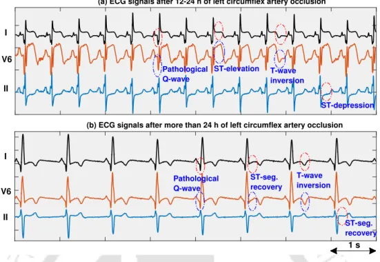 Figure 1.8: Illustrates the dynamic changes in pathological ECG characteristics during the disease progression