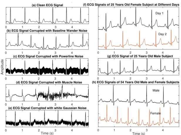 Figure 1.13: Different types of noises obscure the ECG morphological characteristics. (a) Clean ECG signal, (b) ECG corrupted with respiratory baseline wander noise, (c) ECG corrupted with powerline interference, (d) ECG corrupted with muscle contraction n
