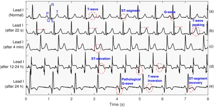 Figure 2.1: Illustrates the dynamic changes in pathological ECG characteristics during the MI progression at lateral lead I for an LCx coronary artery occlusion subject