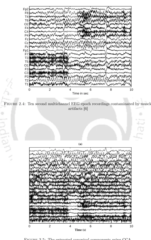 Figure 2.4: Ten second multichannel EEG epoch recordings contaminated by muscle artifacts [6]