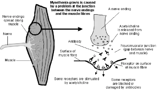 Fig. 5: Myasthenia gravis 