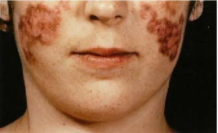Fig. 6: Systemic lupus erythematosus (SLE) .Classical butterfly rash on cheeks. 