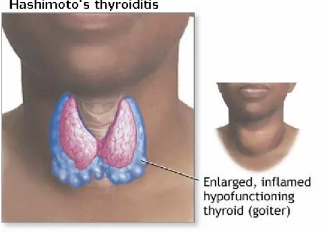 Fig. 1: Hashimoto’s thyroiditis 