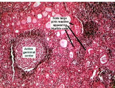 Fig. 2: Hashimoto’s thyroiditis. Chronic inflammatory infiltrate and active lymphoid  germinal centers are seen within the thyroid gland