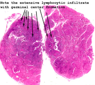 Fig. 3. Lymphoid aggregates with germinal center formation within the thyroid tissue itself  (right).Clusters of lymphocytes as well as fibrosis giving a lobulated look to the thyroid in  general