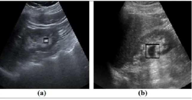 Figure 1.1: Rectangular box show the abnormalities present in kidney (a) stone. (b) cyst.