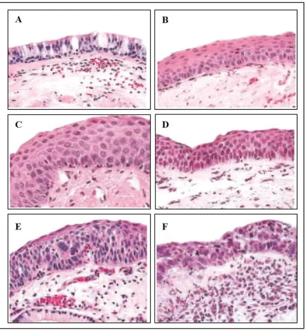 Figure 1.3. Grading of morphological changes in bronchial epithelium used  for classification scheme applied in chemoprevention and other studies at the  University  of  Colorado  Cancer  Centre