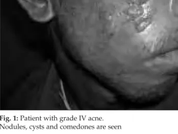 Fig. 1: Patient with grade IV acne.