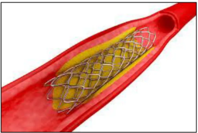 Figure 3: Stent implant 