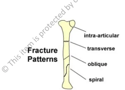 Figure 2.2: The patterns of fracture diaphysis long bone (Dent, 2008) 