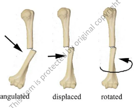 Figure 2.3: The types of malalignment condition on phalanx long bone (Dent, 2008). 