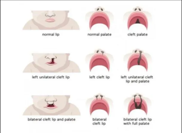 Figure 2.4:  Types of cleft palate. Adapted from bettersafercare.vic.gov.au/clinical-  guidance/neonatal/cleft-lip-and-palate-in-neonates 