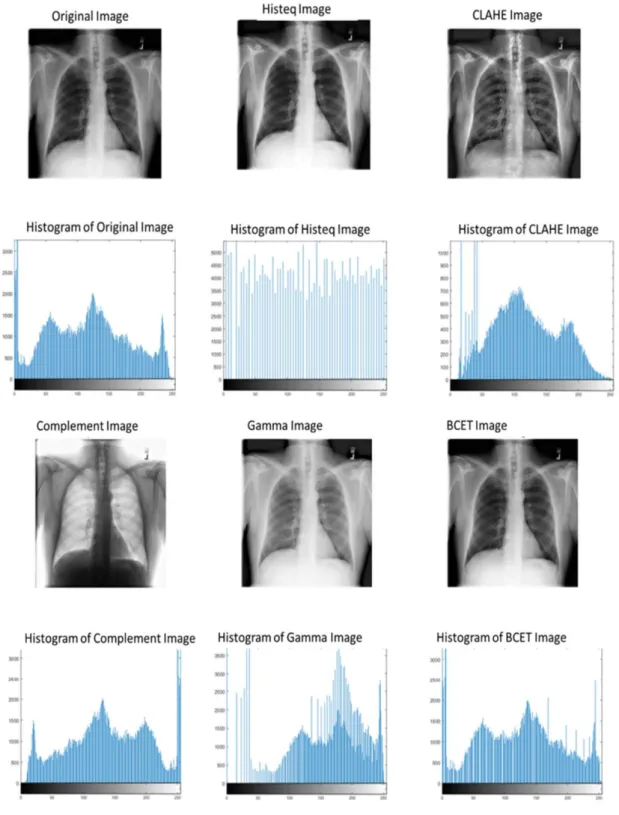 Figure  7: Histogram for original X‐ray image and images undergo different  enhancement techniques[17]