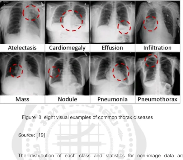 Figure  8: eight visual examples of common thorax diseases  Source: [19] 