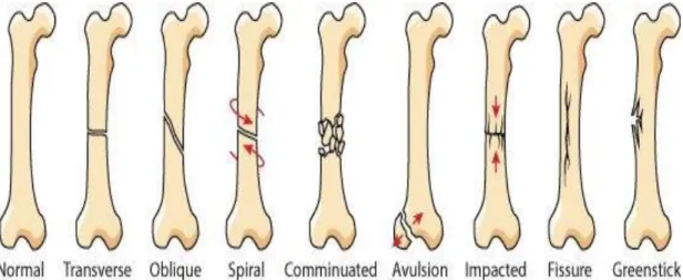 Figure 1: Types of facture (Unger et al., 1990)  2.3. Etiology of fracture in dogs and cats 